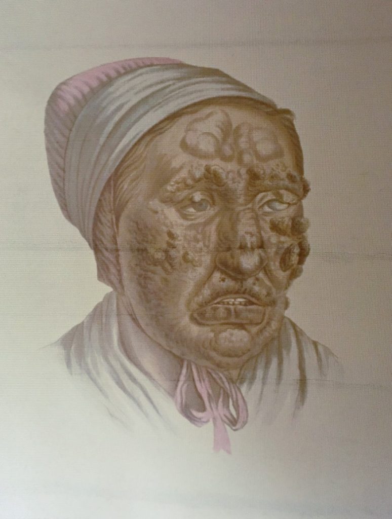 A picture of a leprosy patient in Bergen, Norway. Photo: David Nikel.